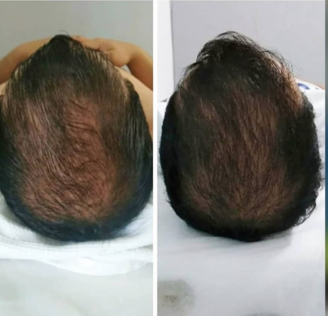 Resultado real de tratamento de saúde capilar, antes e depois